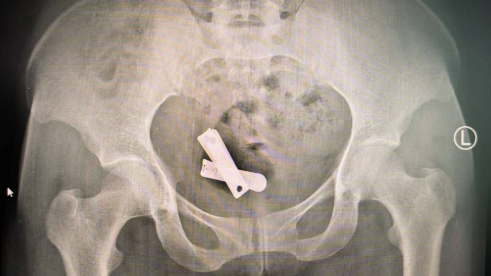 Дәрігерлер әйелдердің жатырынан: құм, пластик, тырнақ алған.