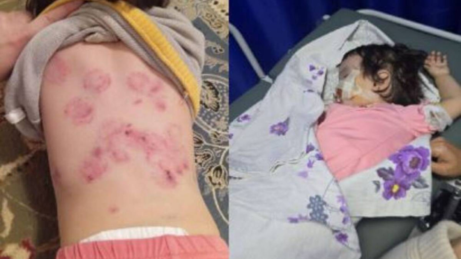 Қызылорда облысындағы балабақшада баланы тістеп тастаған.