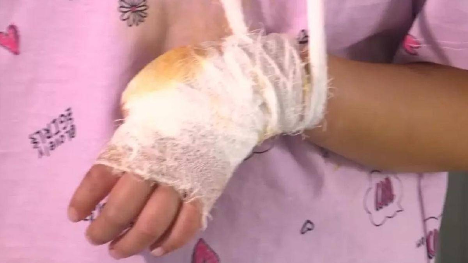 Ақтөбеде аттракционға мінген 5 жасар қыздың саусағы жұлынып кетті