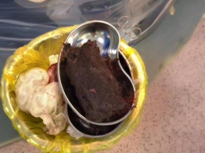 15 жастағы қыздың ішінен 1 келі шаш шықты