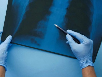 Қазақстанда шылым шегетін азаматтар өкпе обырына тегін тексеріле алады