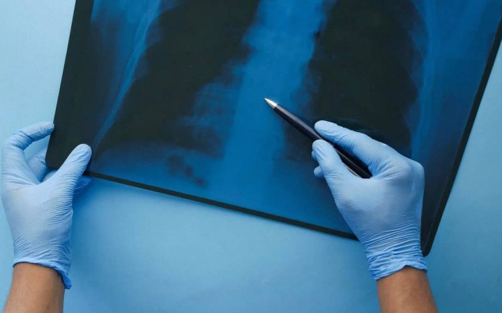 Қазақстанда шылым шегетін азаматтар өкпе обырына тегін тексеріле алады