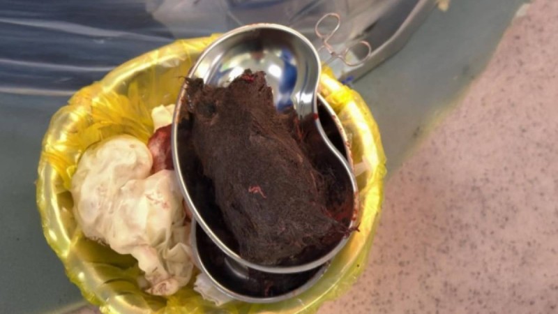 15 жастағы қыздың ішінен 1 келі шаш шықты