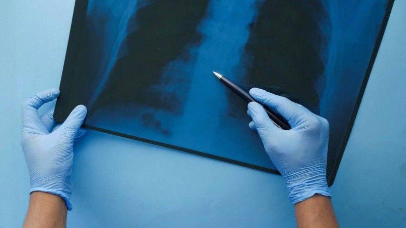 Қазақстанда шылым шегетін азаматтар өкпе обырына тегін тексеріле алады
